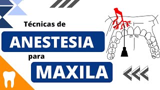 Entenda as TÉCNICAS ANESTÉSICAS PARA MAXILA [upl. by Fuhrman]