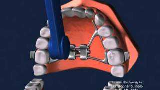 Seattle Orthodontist Dr Christopher Riolo Banded Expander RPE [upl. by Yasdnil]