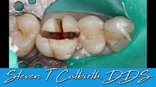 Sectioning and Extraction of Maxilary First Molar  with Steven T Cutbirth DDS [upl. by Haimirej]