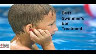 Swimmers Ear Treatment  Auburn Medical Group [upl. by Alesiram]