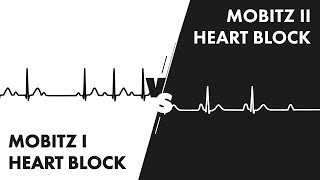 Mobitz Type I vs Type II Second Degree Heart Block [upl. by Adnoved]