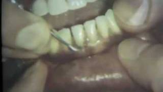 Scaling and Root Planing Part II Mandibular Teeth [upl. by Erot]