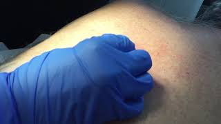 Back Cyst Excision [upl. by Kelvin]