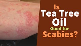 Tea Tree Oil for Scabies Does It Kill Scabies [upl. by Janot]