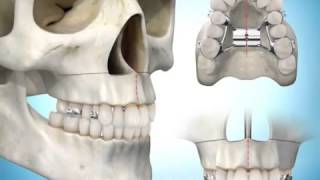Expansão da maxila cirurgicamente assistida [upl. by Ylluz]