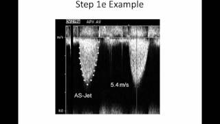 Intro to Aortic Stenosis [upl. by Yebba]