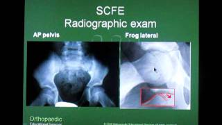 Slipped Capital Femoral Epiphysis SCFE [upl. by Akzseinga353]