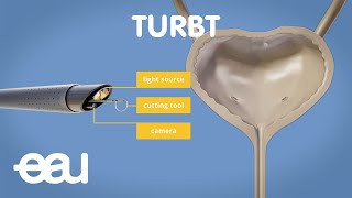 Bladder cancer treatment TURBT [upl. by Ahseya]