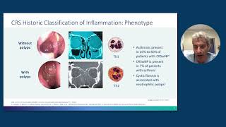 Rhinosinusitis With Nasal Polyps From Pathophysiology to Management [upl. by Iramo]