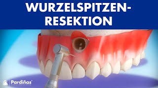 Wurzelspitzenresektion © [upl. by Imoyn227]