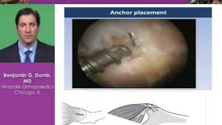 Gluteus Medius Tears Techniques and Indications [upl. by Myrt]