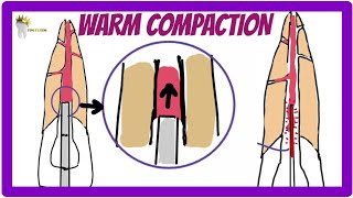 ENDODONTICS  OBTURATION TECHNIQUES  Warm Vertical Compaction technique [upl. by Nnednarb977]