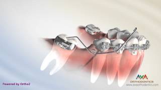 Orthodontic Treatment for Molar Uprighting  Cantilever Spring [upl. by Ylebmik]