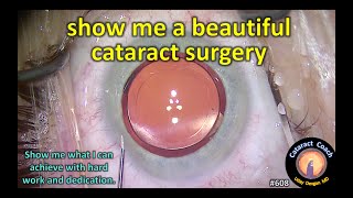 iH during phacoemulsification cataract surgery  ID 124528 [upl. by Htebasile]