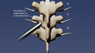 Thoracic laminectomy procedure with removal of ossified ligamentum flavum [upl. by Selina]