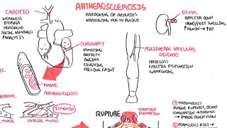 Atherosclerosis  Pathophysiology [upl. by Amadeus621]