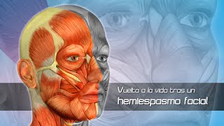 Hemiespasmo Facial Clínica Las Condes [upl. by Gilead106]