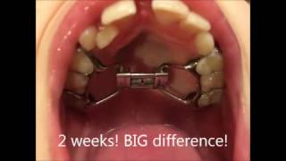 Rapid Maxillary Expansion RME  12 months in a few minutes [upl. by Lerret827]