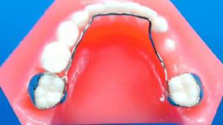 Lingual arch Dental Appliance SMLGlobal [upl. by Nettle]