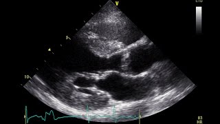 PVC Echo Parasternal Long Axis View  Aortic Stenosis [upl. by Dammahom]