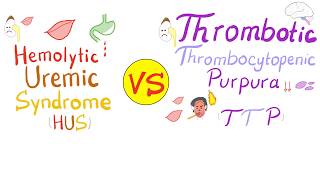 Hemolytic Uremic Syndrome HUS vs Thrombotic Thrombocytopenic purpura TTP [upl. by Acyre]