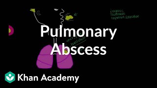 Pulmonary abscess  Respiratory system diseases  NCLEXRN  Khan Academy [upl. by Mighell]