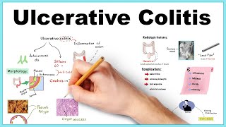 Management of acute severe ulcerative colitis [upl. by Atsocal]