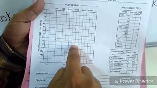 How to interpret a Pure Tone Audiogram PTA [upl. by Kcyrred]