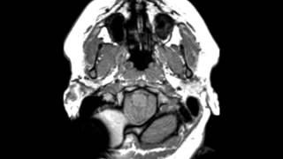 Chiari II Malformation [upl. by Ferree]