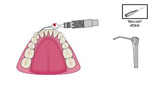 OrthoFlexTech Fixed Lingual Retention Wire [upl. by Dorcus190]