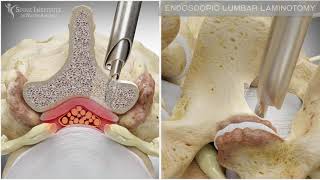 Endoscopic Lumbar Laminotomy  Spine Institute of North America [upl. by Oab]