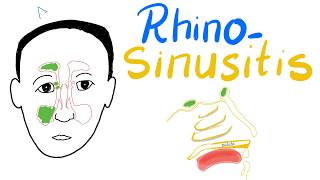 Rhinosinusitis Acuteamp Chronic Clinical Picture Diagnosisamp Management  Cases [upl. by Ahseuqal]