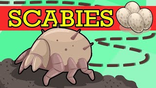 SCABIES Causes Signs and Symptoms Diagnosis and Treatment [upl. by Atinram273]