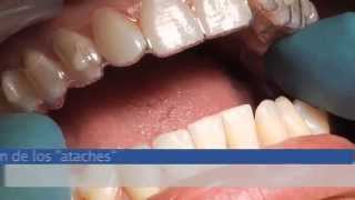 Ortodoncia Invisible Invisalign [upl. by Ivo]