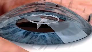 What is a Cataract  Cataract surgery video [upl. by Portia]