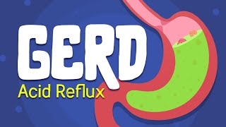 Why is your Stomach Burning  Acid Reflux  GERD Treatment and symptoms [upl. by Agiaf648]