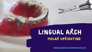 LingualArchforMolarUprighting [upl. by Gerk]