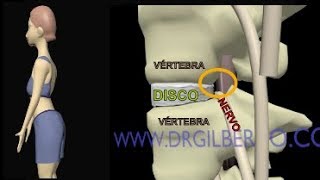 Hernia de Disco  Extrusão Discal  Protusão  Abalamento Dr Gilberto explica [upl. by Amme]