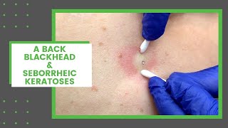 A Back Blackhead amp Seborrheic Keratoses  Dr Derm [upl. by Ahaelam]