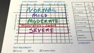 How to Read an Audiogram [upl. by Retepnhoj]