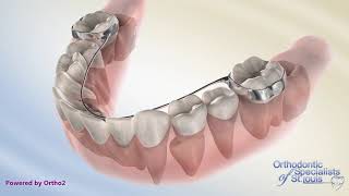 Lingual Arch  Orthodontics [upl. by Caassi]