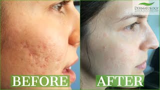 ICE PICK SCAR Acne Results Testimonial  TCA CROSS  Dr Ben Behnam  Los Angeles [upl. by Weikert]