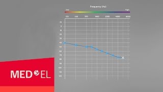 Audiograms Explained  MEDEL [upl. by Limaa]