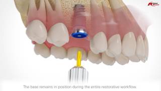 Full Arch Dental Implant Surgery Options amp Costs [upl. by Yddur901]