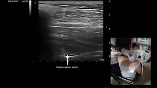 suprascapular nerve block [upl. by Ham]