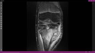 Osteomielite crônica com abscesso de Brodie [upl. by Eugen]